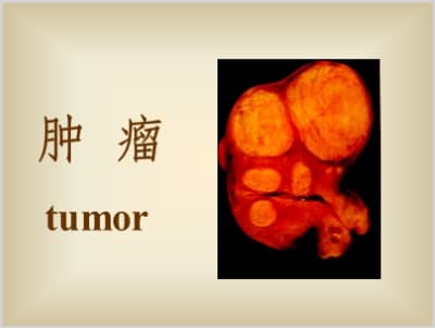 肿瘤--肿瘤的分化与异型性.ppt